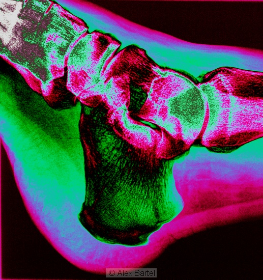 Coloured x-ray, ankle