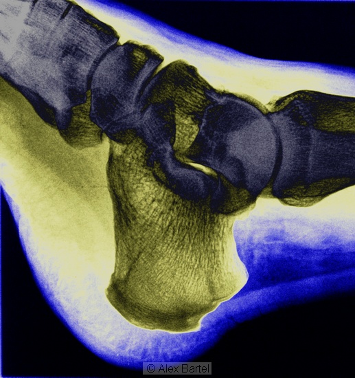 Coloured x-ray, ankle